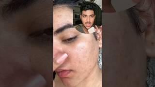 लड़की के सारे  "pimples" खत्म कर दिए  #shorts