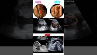 Baby Girl or baby boy,how they appear on ultrasound 2,3D #shortsfeed #shorts #baby