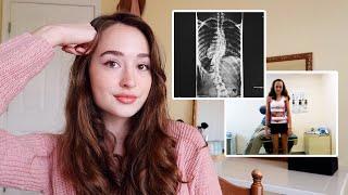 My Journey With Severe Scoliosis | Q&A