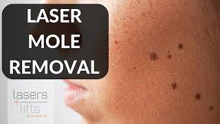 LASER MOLE REMOVAL