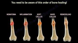 How Does Broken Bone Heal?