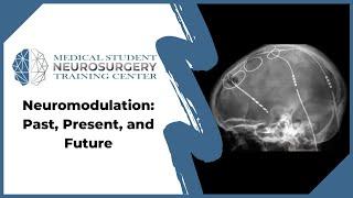 Neuromodulation: Past, Present, and Future