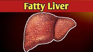 Fatty Liver?  Treatment of Fatty liver? | Symptoms of Fatty Liver | Fatty Liver Complete Guide