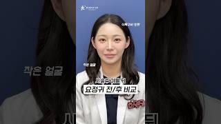귀필러 전후 비교! 원장님 셀프시술