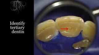 Managing calcified canals, part 1