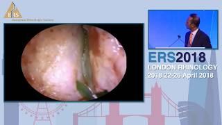 ERS London 2018, Dacryocystorhinostomy And Lacrimal Surgery, Salil Nair