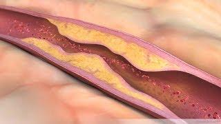 What is Atherosclerosis?