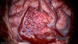 Microsurgical Resection of a Lateral Parietal Arteriovenous Malformation