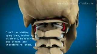 C1 and C2 Atlantoaxial Instability: Upper Cervical Instability and Prolotherapy animation