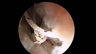 Joshua Harris, MD - Interportal capsulotomy repair / plication