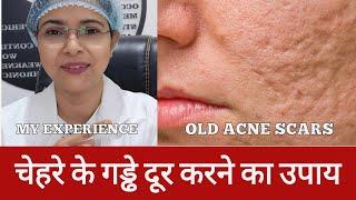 चेहरे पर गड्ढे ACNE SCARS ठीक करने का BEST तरीका #acnescars #skin #trending