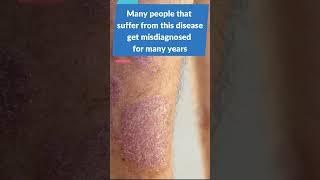 Can Psoriasis cause Arthritis? Learn about Psoriatic Arthritis!