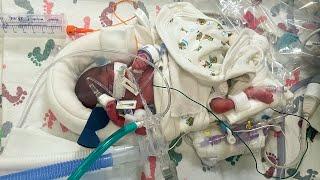 Baby Born at 22 Weeks Saved by Sacramento Firefighters and UC Davis