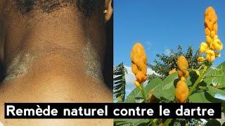 Remède naturel contre le dartre: Solutions efficaces et faciles à appliquer.