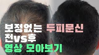 보정없는 두피문신 전후 영상 모아보기