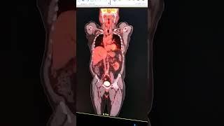 Whole Body PET Scan (positron emission tomography)