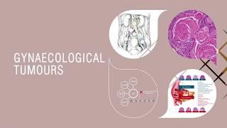 Gynaecological Tumours: Essentials for Clinicians