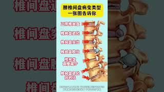 腰椎间盘突出 骨科专家李俊海 腰疼腿疼 腰椎疼痛 抖出健康知识宝藏