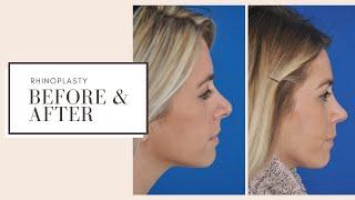 Plastic Surgery Before & After | Rhinoplasty | ESKMD NYC