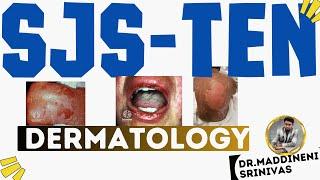 Stevens Johnson Syndrome | Toxic Epidermal Necrolysis | SJS TEN | Clinical features | Management |