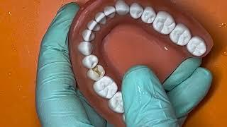 Adex class 2 mesial dtx premolar composite preparation #20