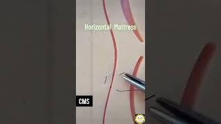 Horizontal Mattress technique. Sutures technique. Stitches technique.