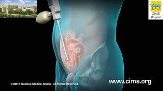 Inguinal Hernia (Hindi) - CIMS Hospital