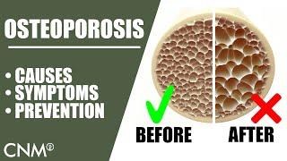 OSTEOPOROSIS: The Natural Way To Prevent It