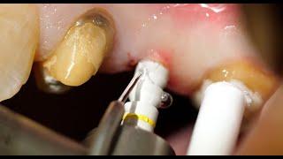 Placement of a Z-Systems Upper Premolar Implant to Repair a Bridge