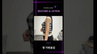 팔 지방흡입 후기 #지방흡입후기