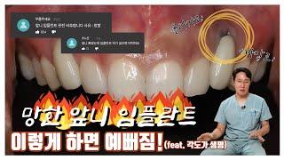 앞니 임플란트 치료 후 잇몸이 올라가는 이유와 그 해결방법에 대해서 알려드립니다! (FEAT.각도의 중요성)