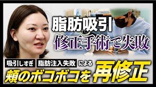 【修正手術に密着】他院スタッフさんの2回目の修正手術を担当。窪み、ボコボコ、脂肪取り残しを改善したい【顔の脂肪吸引】