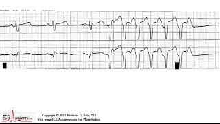 ECG Interpretation Tutorial - ChalkTalk 01 Intermediate Level