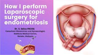 How I perform laparoscopic surgery for endometriosis