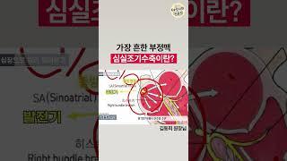 심장이 덜컹! 가장 흔한 부정맥, 심실조기수축이 발생하는 이유는?