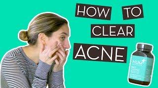 Breaking Out Much? How To Clear Acne!