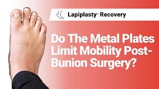Do The Metal Plates Limit Mobility Post-Bunion Surgery? | Lapiplasty® Recovery