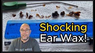 Shocking Ear Wax! #ear #earwax #earwaxremoval #earcleaning #earwaxclinic #earwaxextraction #asmr