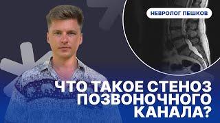 ЧТО ТАКОЕ СТЕНОЗ ПОЗВОНОЧНОГО КАНАЛА ? Невролог Пешков