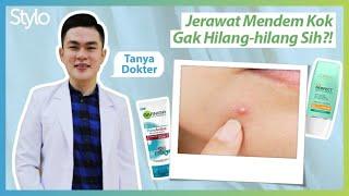 Jerawat Mendem / Batu Akibat Komedo? Ini Skincare & Cara Mengilangkan dari Dokter Kulit | Stylo.ID