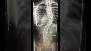 6 months of the non-surgical ASMI treatment for Scoliosis