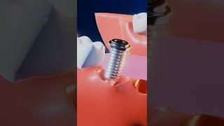 Dental Implants #dentist #tredding #tredind #trending #shortvideo #implants #dentaltechnology