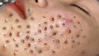 Blackhead Removal With Sac Dep Spa @10007285