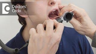 What are tonsil stones and its causes? - Dr. Sriram Nathan