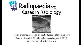 Tension pneumoperitoneum on the background of infective colitis (Radiopaedia.org) Cases in Radiology