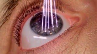 WaveLight Augenlaser bei EyeLaser