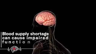 What is Stroke ?