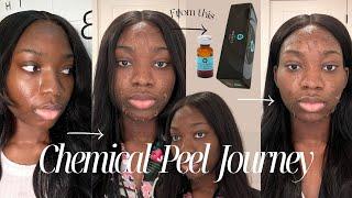 CHEMICAL PEEL | The perfect derma peel, Hyperpigmentation +Texture, Before & After on DARK SKIN