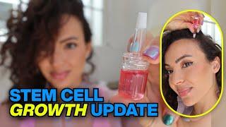 Stem Cell Hair Growth Update (Calecim UPDATE on My Hair Loss)