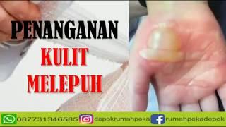 Cara Perawatan Luka Bakar Kulit Melepuh | Punya Luka yang Sulit Sembuh ? Hub : 087731346585